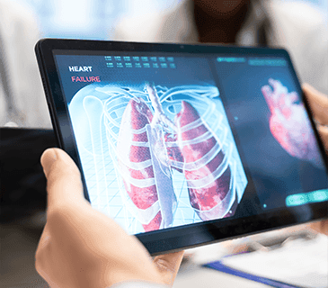 Nódulos Pulmonares